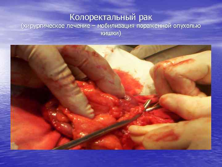 Колоректальный рак (хирургическое лечение – мобилизация пораженной опухолью кишки) 