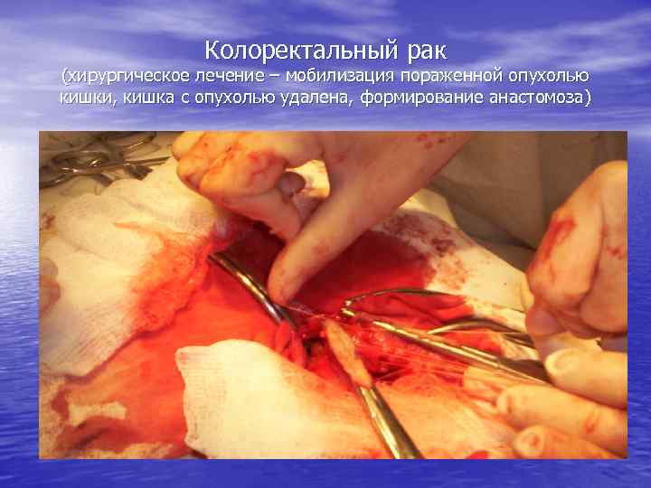 Колоректальный рак (хирургическое лечение – мобилизация пораженной опухолью кишки, кишка с опухолью удалена, формирование