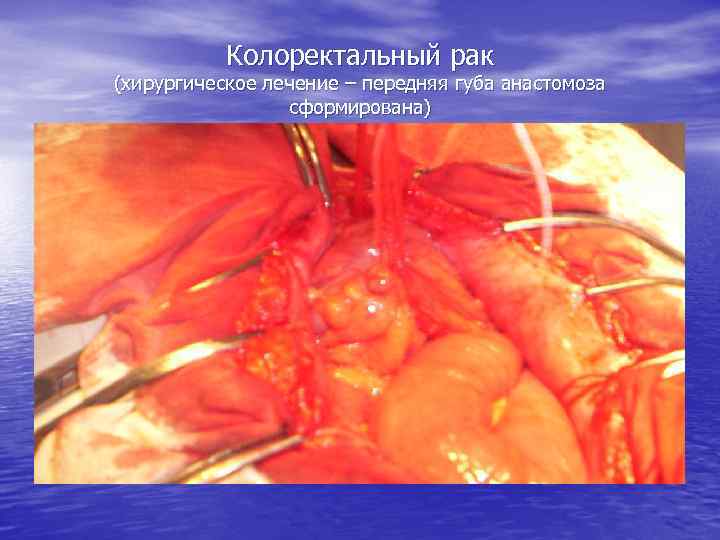 Колоректальный рак (хирургическое лечение – передняя губа анастомоза сформирована) 
