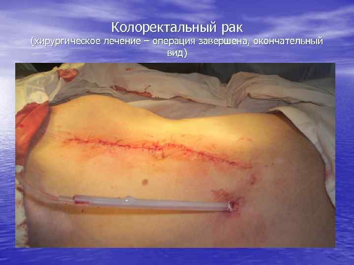 Колоректальный рак (хирургическое лечение – операция завершена, окончательный вид) 