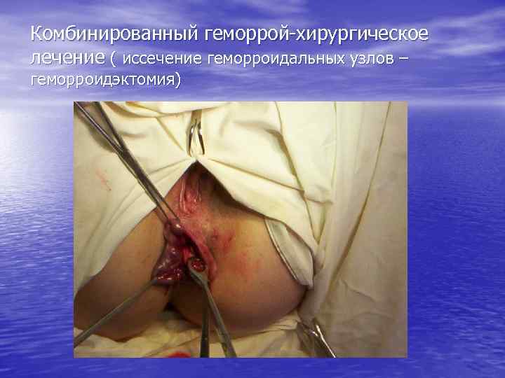 Комбинированный геморрой-хирургическое лечение ( иссечение геморроидальных узлов – геморроидэктомия) 