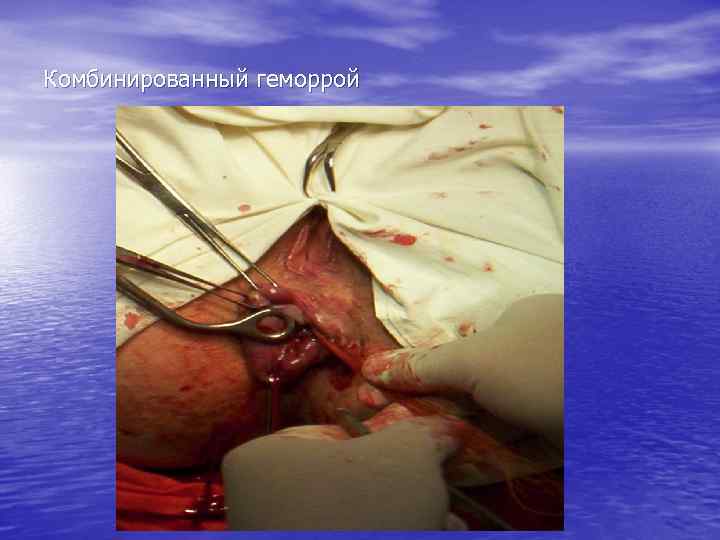 Комбинированный геморрой 
