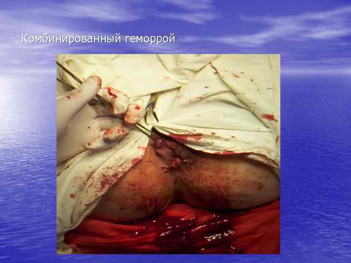 Комбинированный геморрой 