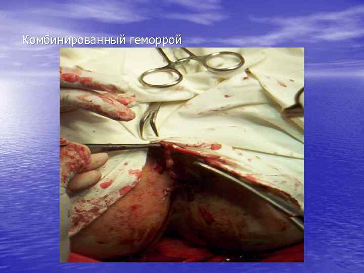 Комбинированный геморрой 
