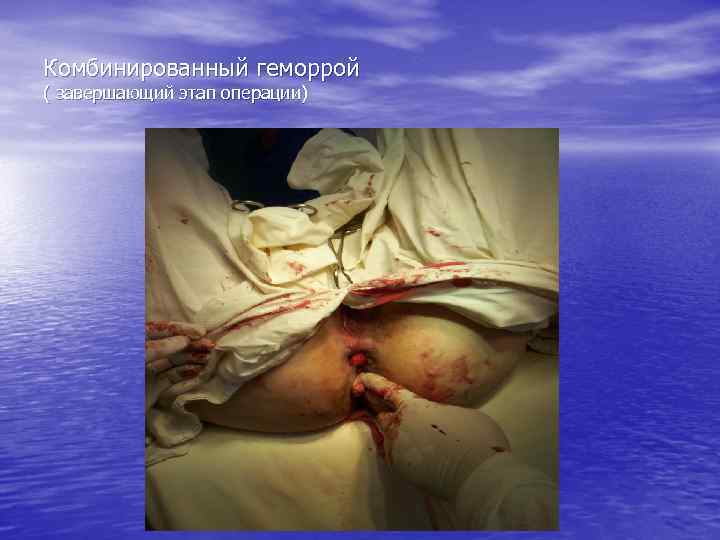 Комбинированный геморрой ( завершающий этап операции) 