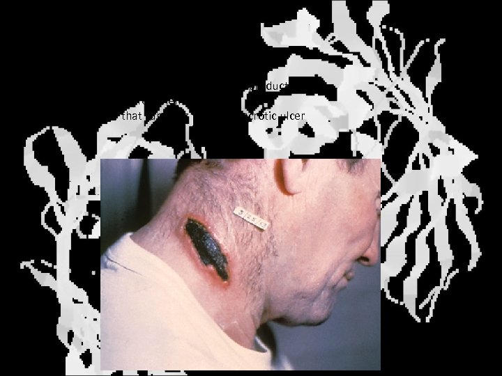 Cutaneous anthrax • • Most common non-intended form Handling of infected animals or animal