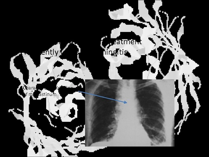 Inhalation anthrax • Inhalation of spores • High lethality even with treatment • Frequently