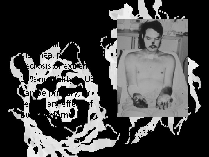 Septicemic Plague • Fever, chills, vomiting, diarrhea, purpura, and necrosis of extremities • 33%