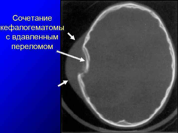 Сочетание кефалогематомы с вдавленным переломом 