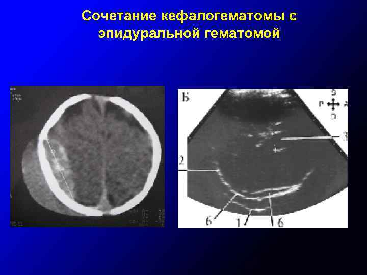 Сочетание кефалогематомы с эпидуральной гематомой 