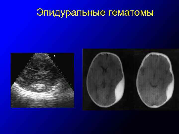 Эпидуральные гематомы 