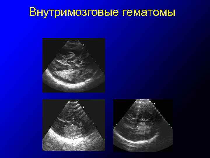 Внутримозговые гематомы 