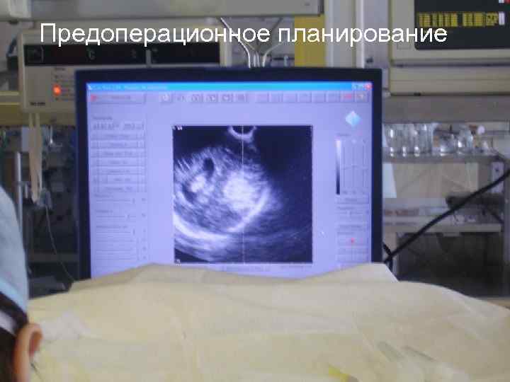 Предоперационное планирование 