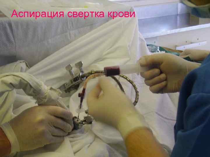 Аспирация свертка крови 