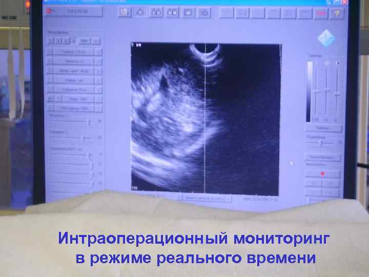 Интраоперационный мониторинг в режиме реального времени 