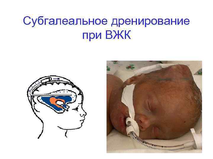 Субгалеальное дренирование при ВЖК 