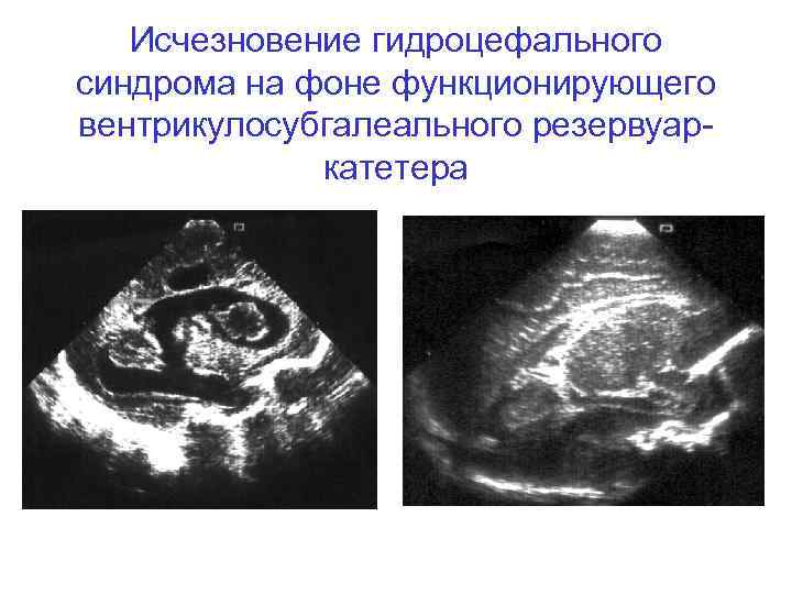 Исчезновение гидроцефального синдрома на фоне функционирующего вентрикулосубгалеального резервуаркатетера 
