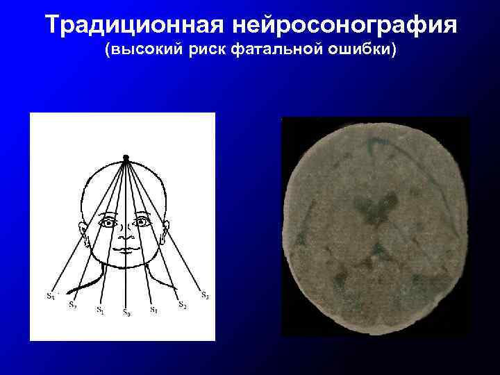 Традиционная нейросонография (высокий риск фатальной ошибки) 