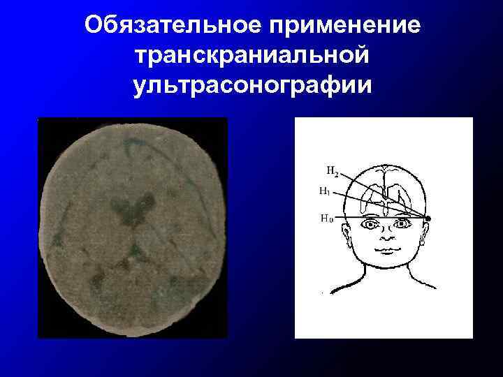 Обязательное применение транскраниальной ультрасонографии 