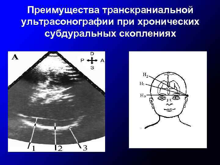 Преимущества транскраниальной ультрасонографии при хронических субдуральных скоплениях 