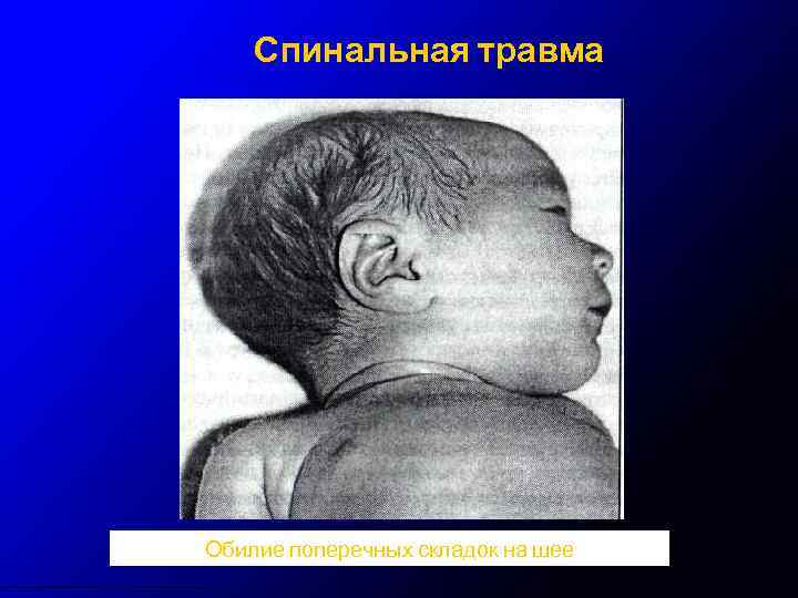 Спинальная травма Обилие поперечных складок на шее 