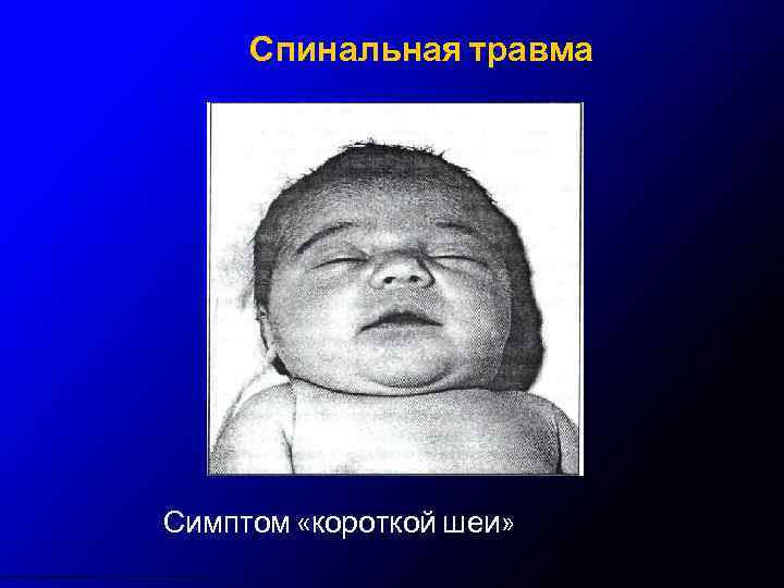 Спинальная травма Симптом «короткой шеи» 