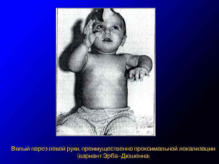 Вялый парез левой руки, преимущественно проксимальной локализации (вариант Эрба—Дюшенна) 