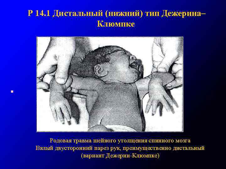 Р 14. 1 Дистальный (нижний) тип Дежерина– Клюмпке • Родовая травма шейного утолщения спинного