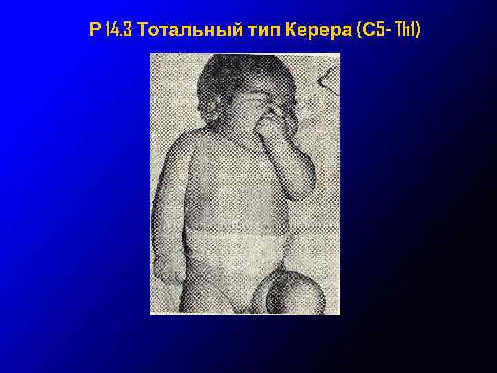 Р 14. 3 Тотальный тип Керера (С 5 - Th 1) 