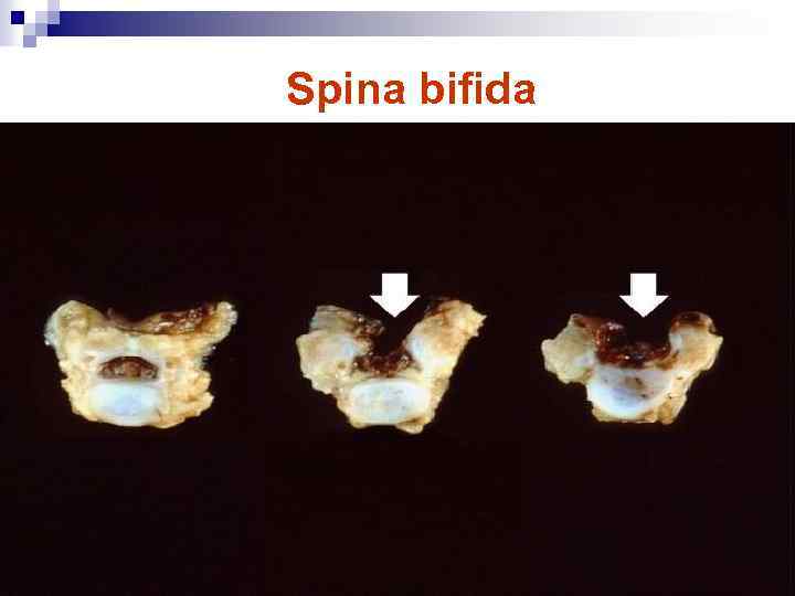 Spina bifida 