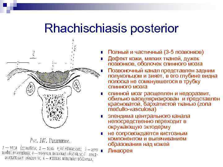 Rhachischiasis posterior n n n n Полный и частичный (3 -5 позвонков) Дефект кожи,