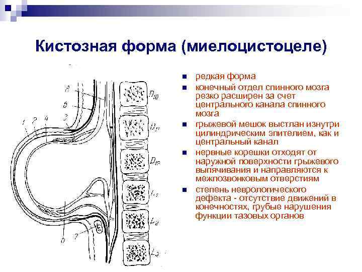 Кистозная форма (миелоцистоцеле) n n n редкая форма конечный отдел спинного мозга резко расширен