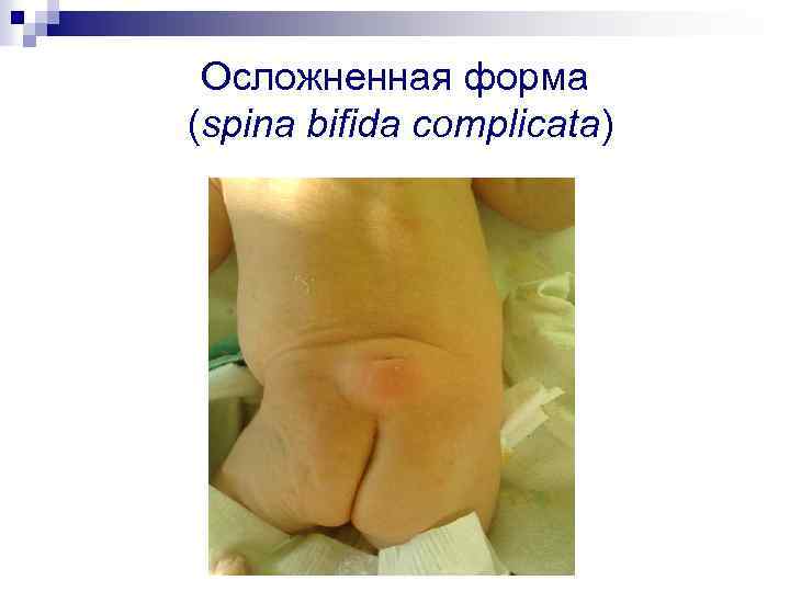 Осложненная форма (spina bifida complicata) 