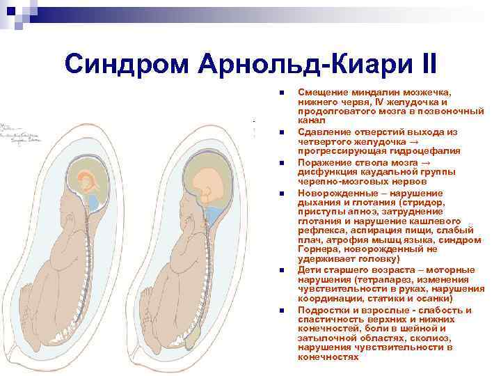 Синдром Арнольд-Киари II n n n Смещение миндалин мозжечка, нижнего червя, IV желудочка и