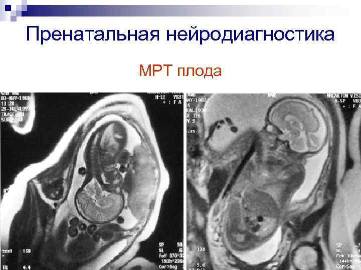 Пренатальная нейродиагностика МРТ плода 