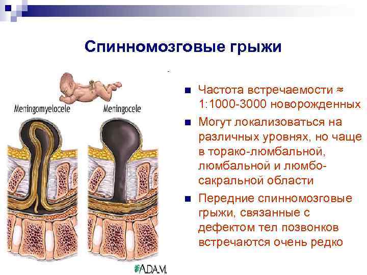 Спинномозговые грыжи n n n Частота встречаемости ≈ 1: 1000 -3000 новорожденных Могут локализоваться