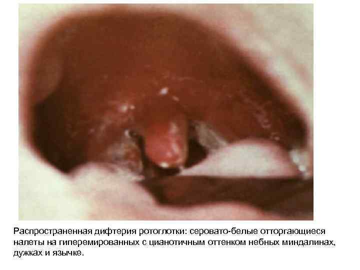 Распространенная дифтерия ротоглотки: серовато-белые отторгающиеся налеты на гиперемированных с цианотичным оттенком небных миндалинах, дужках