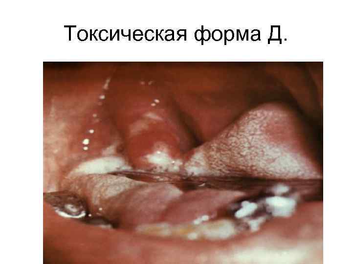 Токсическая форма Д. 