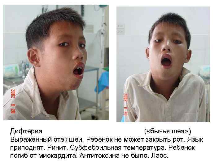 Дифтерия ( «бычья шея» ) Выраженный отек шеи. Ребенок не может закрыть рот. Язык