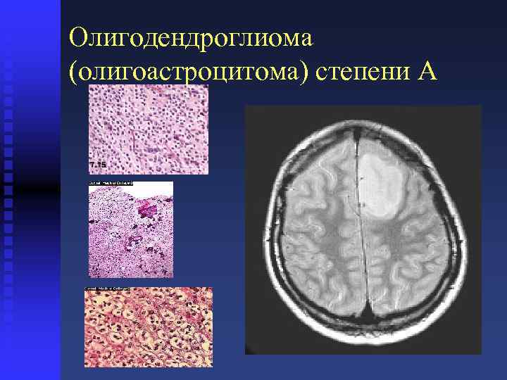 Олигодендроглиома (олигоастроцитома) степени A 