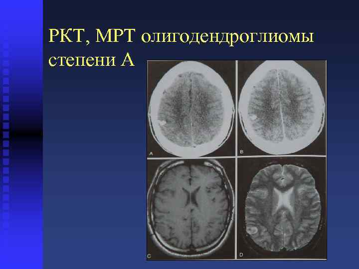 РКТ, МРТ олигодендроглиомы степени A 