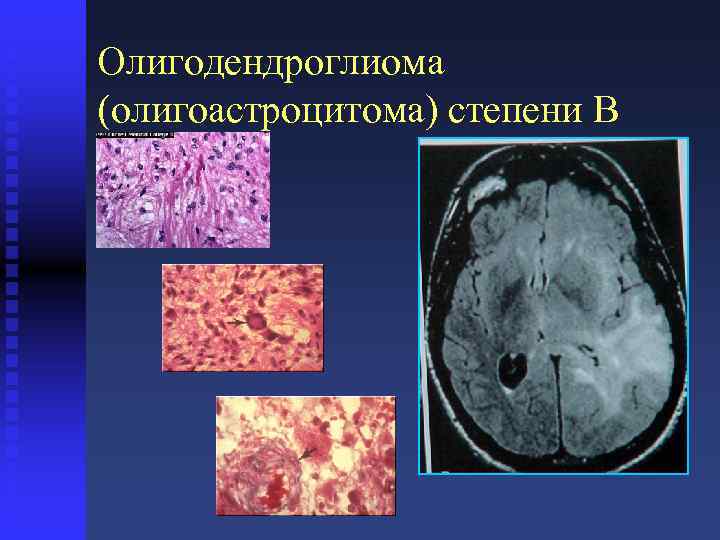 Олигодендроглиома (олигоастроцитома) степени B 