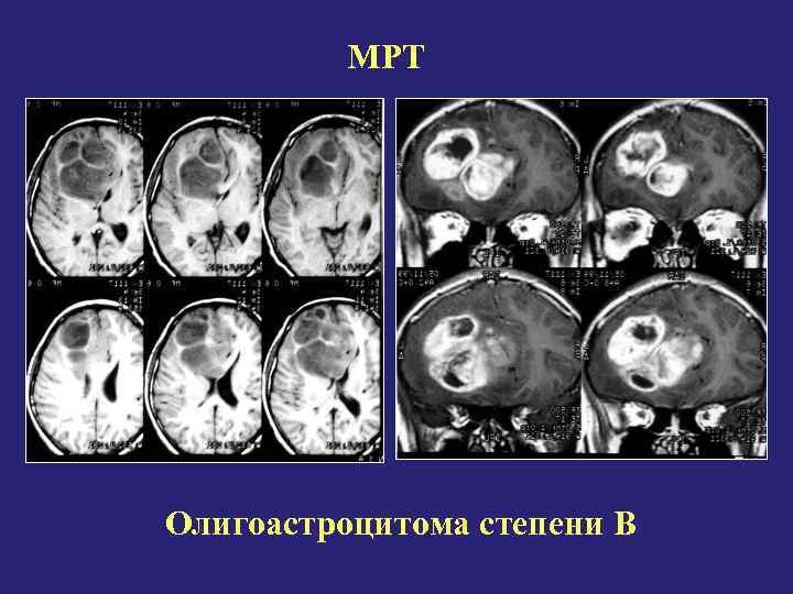  МРТ Олигоастроцитома степени В 