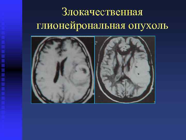 Злокачественная глионейрональная опухоль 