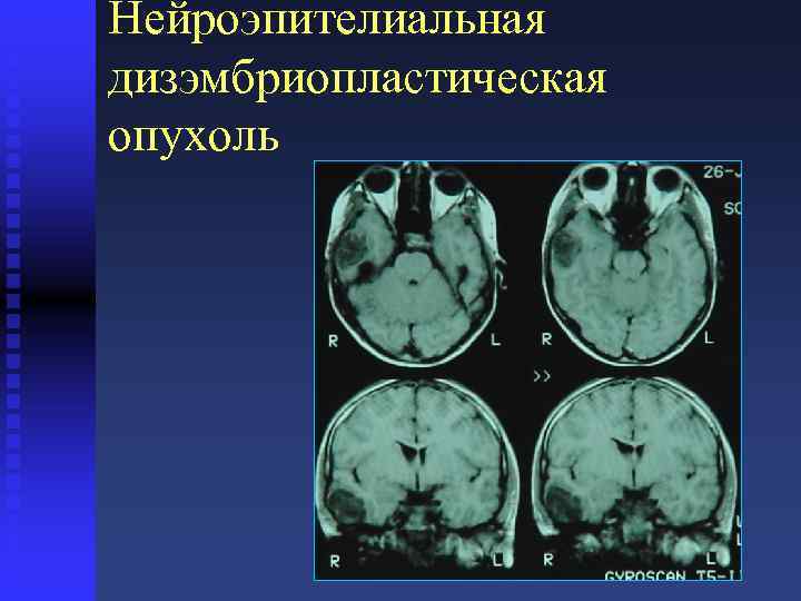 Мультинодулярная вакуолизирующая нейрональная опухоль мрт картинки