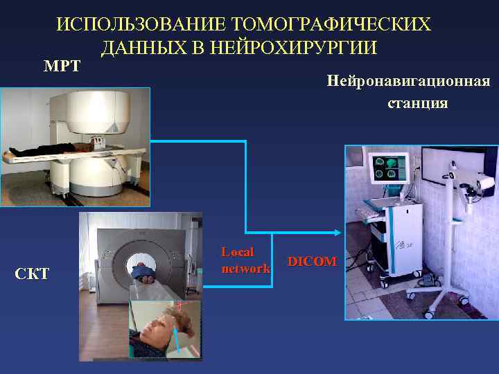  ИСПОЛЬЗОВАНИЕ ТОМОГРАФИЧЕСКИХ ДАННЫХ В НЕЙРОХИРУРГИИ МРТ Нейронавигационная станция СКТ Local DICOM network 