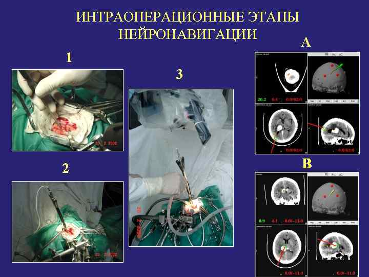 ИНТРАОПЕРАЦИОННЫЕ ЭТАПЫ НЕЙРОНАВИГАЦИИ 1 3 2 B 