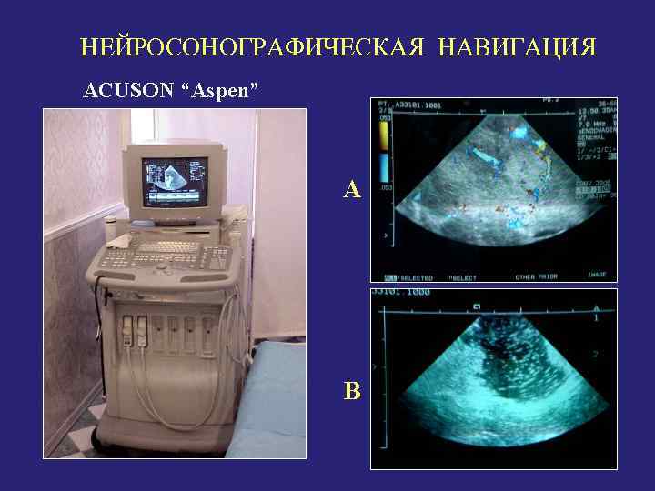 НЕЙРОСОНОГРАФИЧЕСКАЯ НАВИГАЦИЯ 