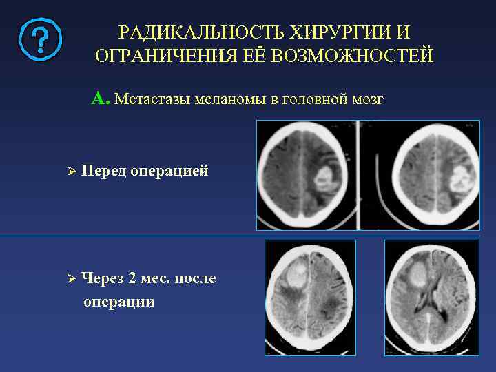 Меланома метастазы в головной мозг