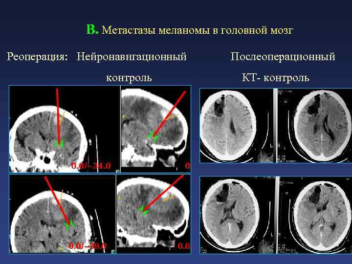Как выглядят метастазы в головном мозге фото